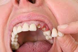 Photo of दांतों का दर्द जब हो जाए बर्दाश्त से बाहर, इन घरेलू उपायों से जल्द मिलेगा आराम