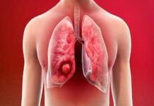 गलत खानपान और लाइफस्टाइल की वजह से युवा भी हो रहे Kidney Stone के शिकार